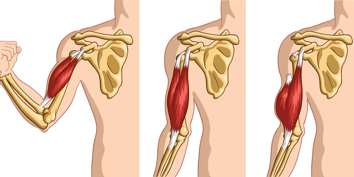 biceps tendon tears, shoulder doctor in Gurgaon, best orthopedic in Gurgaon