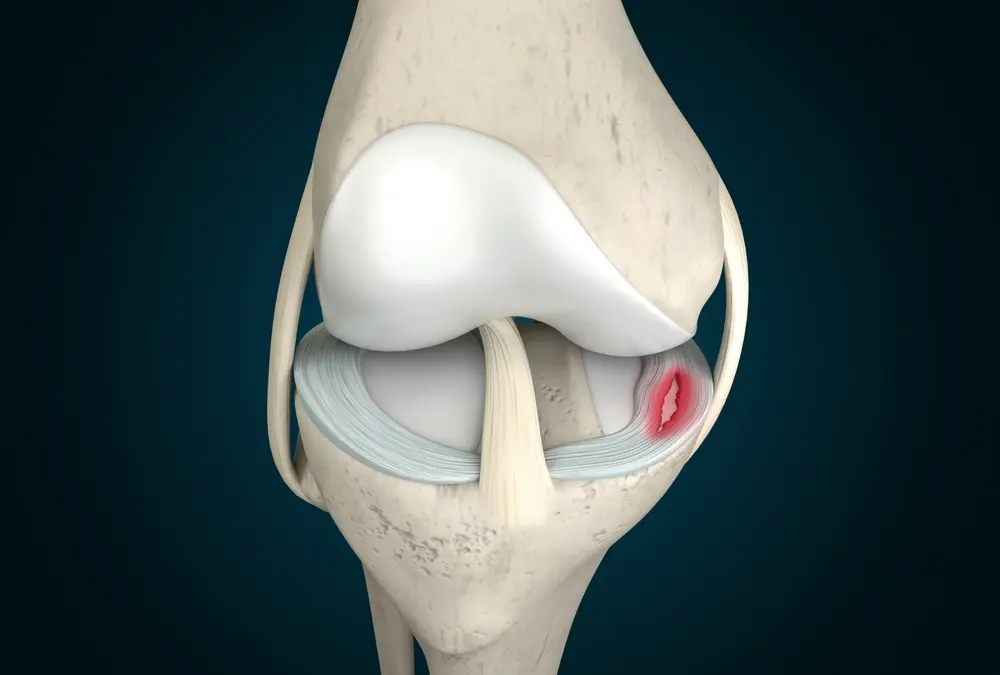 meniscus tears, Dr. Chirag Arora, best orthopedic in Gurgaon, best knee doctor in gurgaon