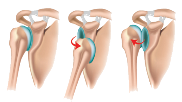 shoulder dislocations, best shoulder doctor in Gurgaon, dr. Chirag Arora, best ortho in Gurgaon