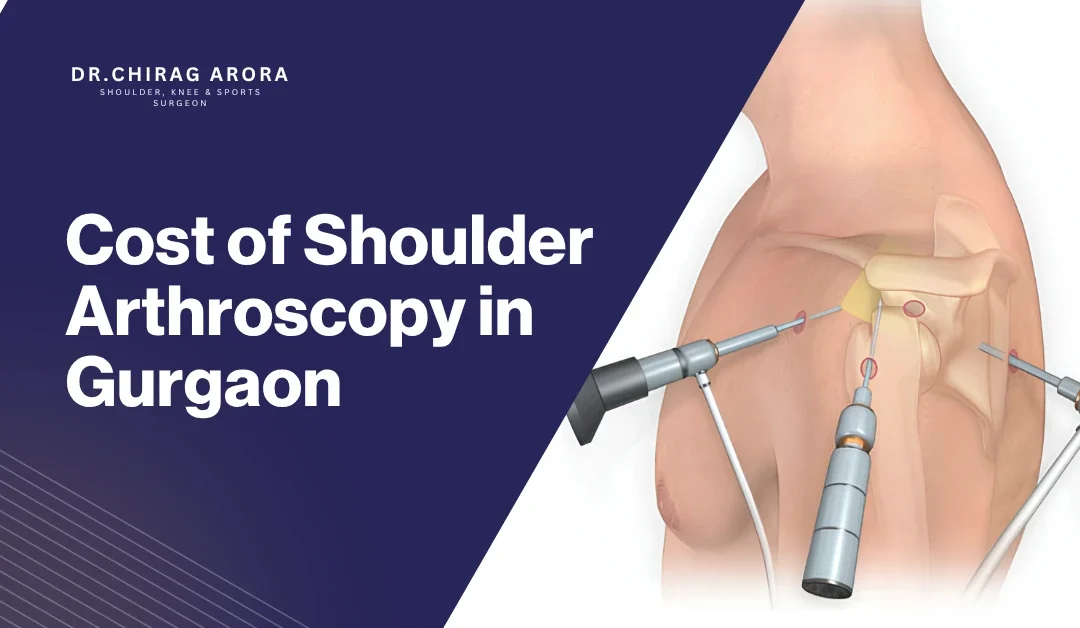 Cost of Shoulder Arthroscopy in Gurgaon