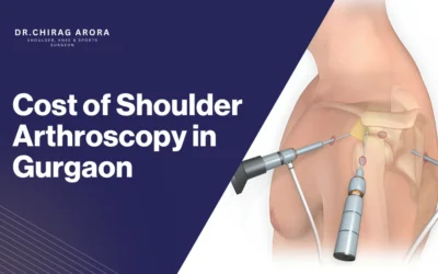 Cost of Shoulder Arthroscopy in Gurgaon