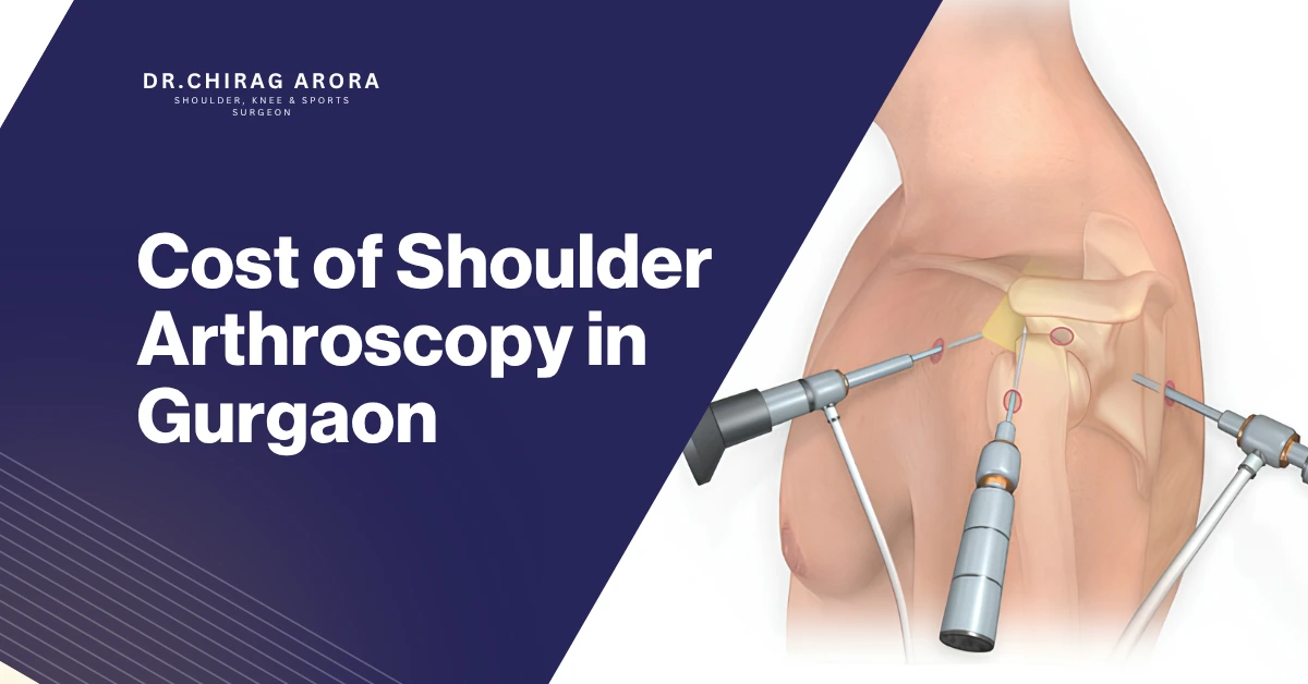 Cost of Shoulder Arthroscopy in Gurgaon, shoulder arthroscopy cost Gurgaon, shoulder arthroscopy surgery Gurgaon, Dr. Chirag Arora, orthopedic doctor in Gurgaon, dr chirag arora, shoulder pain treatment Gurgaon, rotator cuff tear surgery Gurgaon, shoulder arthroscopy specialist Gurgaon, sports injury treatment Gurgaon, shoulder dislocation treatment Gurgaon, shoulder surgeon Gurgaon, minimally invasive shoulder surgery, arthroscopic shoulder surgery cost, best orthopedic doctor in Gurgaon, shoulder injury treatment, frozen shoulder treatment Gurgaon, shoulder instability treatment, shoulder joint surgery Gurgaon, sports orthopedic surgeon Gurgaon, arthroscopy surgeon Gurgaon, shoulder repair surgery Gurgaon, orthopedic specialist Gurgaon, shoulder rehabilitation Gurgaon, shoulder surgery recovery