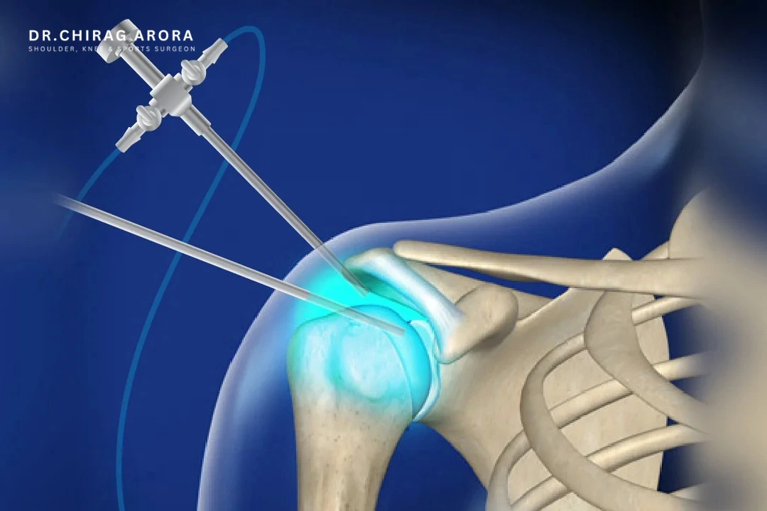 Cost of Shoulder Arthroscopy in Gurgaon, shoulder arthroscopy cost Gurgaon, shoulder arthroscopy surgery Gurgaon, Dr. Chirag Arora, orthopedic doctor in Gurgaon, dr chirag arora, shoulder pain treatment Gurgaon, rotator cuff tear surgery Gurgaon, shoulder arthroscopy specialist Gurgaon, sports injury treatment Gurgaon, shoulder dislocation treatment Gurgaon, shoulder surgeon Gurgaon, minimally invasive shoulder surgery, arthroscopic shoulder surgery cost, best orthopedic doctor in Gurgaon, shoulder injury treatment, frozen shoulder treatment Gurgaon, shoulder instability treatment, shoulder joint surgery Gurgaon, sports orthopedic surgeon Gurgaon, arthroscopy surgeon Gurgaon, shoulder repair surgery Gurgaon, orthopedic specialist Gurgaon, shoulder rehabilitation Gurgaon, shoulder surgery recovery