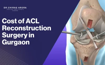 Cost of ACL Reconstruction Surgery in Gurgaon
