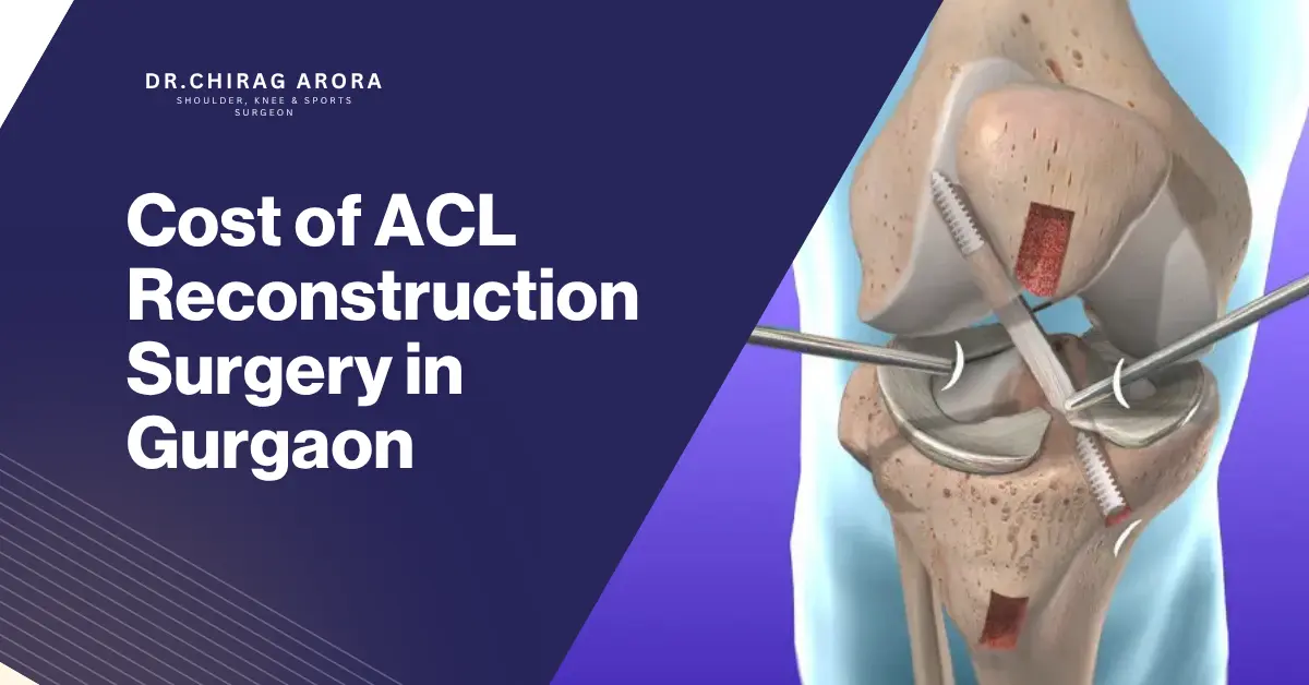 ACL Reconstruction Surgery, ACL Reconstruction Surgery Cost, Cost of ACL Reconstruction Surgery in Gurgaon, ACL Surgery Cost in Gurgaon, ACL Tear Treatment, ACL Injury Treatment, ACL Surgery Gurgaon, ACL Reconstruction Surgeon Gurgaon,Best Orthopedic Surgeon In Gurgaon, Dr. Chirag Arora, ACL Tear Symptoms, ACL Ligament Injury, Anterior Cruciate Ligament Injury, Knee Ligament Surgery, Knee Injury Treatment, Knee Pain Treatment Gurgaon, Sports Injury Treatment Gurgaon, Arthroscopic ACL Surgery, ACL Surgery Recovery, Recovery After ACL Reconstruction, ACL Physiotherapy, Knee Arthroscopy Gurgaon, Orthopedic Doctor Gurgaon, Knee Specialist Gurgaon, Ligament Tear Treatment