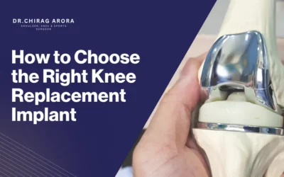 How to Choose the Right Knee Replacement Implant