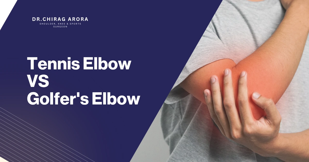 Tennis Elbow Golfer’s Elbow Tennis Elbow vs Golfer’s Elbow Difference between Tennis Elbow and Golfer’s Elbow Tennis Elbow treatment Golfer’s Elbow treatment Tennis Elbow symptoms Golfer’s Elbow symptoms Elbow pain treatment Elbow pain causes Outer elbow pain Inner elbow pain Elbow tendon injury Tendon inflammation treatment Lateral epicondylitis Medial epicondylitis Physiotherapy for Tennis Elbow Physiotherapy for Golfer’s Elbow Orthopedic doctor for elbow pain Best Orthopedic Surgeon In Gurgaon Dr. Chirag Arora Elbow specialist in Gurgaon Sports injury treatment Gurgaon Joint pain treatment Gurgaon Orthopedic treatment Gurgaon