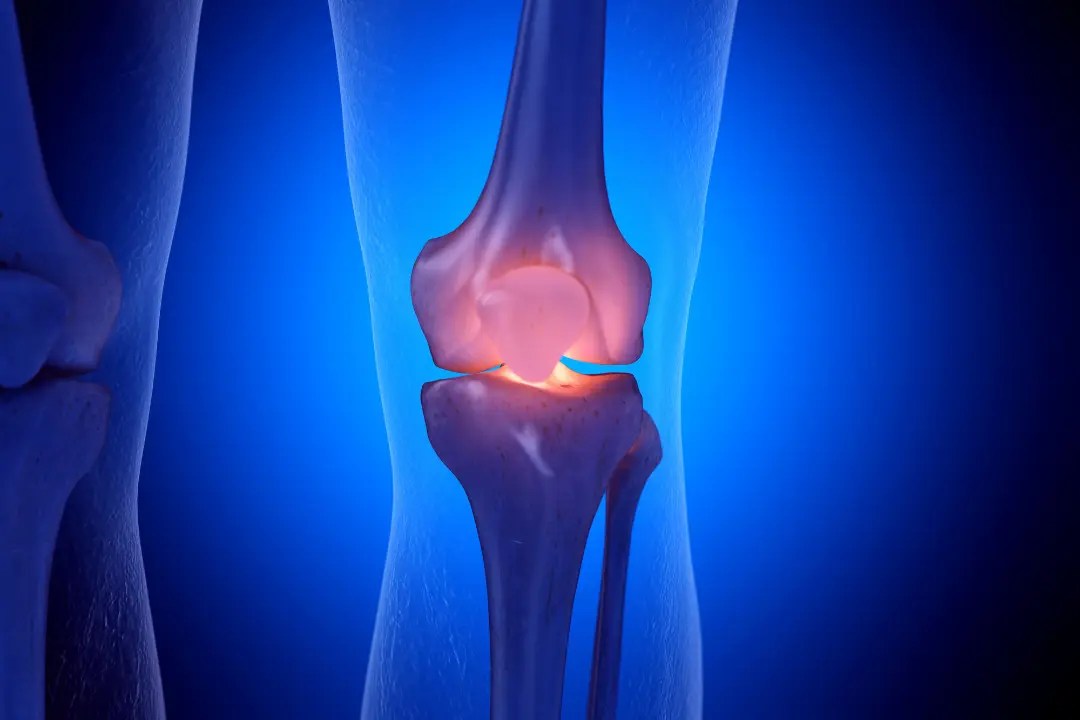 ACL tear symptoms, ACL injury, ACL tear treatment, ACL tear treatment in Gurgaon, ACL surgeon in Gurgaon, best orthopedic surgeon in Gurgaon, Dr. Chirag Arora Best Orthopedic Surgeon In Gurgaon, orthopedic doctor in Gurgaon, sports injury specialist in Gurgaon, knee specialist in Gurgaon, knee pain while walking, knee swelling after injury, knee instability, torn ACL symptoms, ACL reconstruction surgery, arthroscopic ACL surgery, ACL surgery recovery time, ACL tear recovery time, physiotherapy for ACL tear, ACL rehabilitation program, ACL tear treatment without surgery, MRI for ACL tear, meniscus injury, sports injury treatment in Gurgaon, ligament injury treatment, knee ligament surgery, ACL surgery in Gurgaon, knee arthroscopy in Gurgaon, return to sports after ACL surgery and anterior cruciate ligament injury.