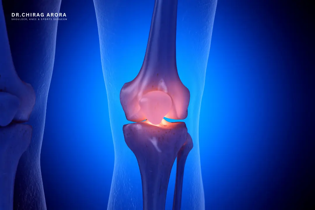 Knee replacement vs knee arthroscopy, knee replacement surgery, knee arthroscopy, knee arthroscopy procedure, arthroscopic knee surgery, total knee replacement, partial knee replacement, knee surgery, best knee surgery, knee pain treatment, knee pain diagnosis, severe knee arthritis, advanced knee osteoarthritis, meniscus tear treatment, ligament injury, cartilage damage, joint replacement surgery, knee replacement recovery, knee arthroscopy recovery, physiotherapy after knee surgery, knee rehabilitation, robotic knee replacement, knee implant, orthopaedic surgeon, minimally invasive knee surgery, treatment for knee arthritis, knee replacement indications, knee locking treatment, non-surgical knee pain treatment, knee treatment options