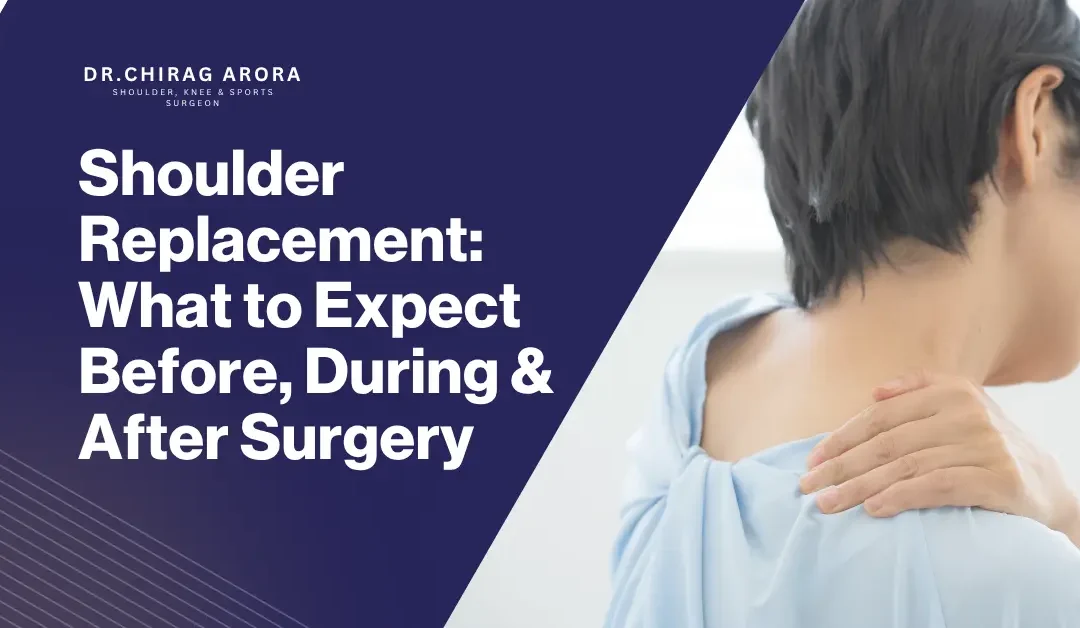 Shoulder Replacement: What to Expect Before, During & After Surgery